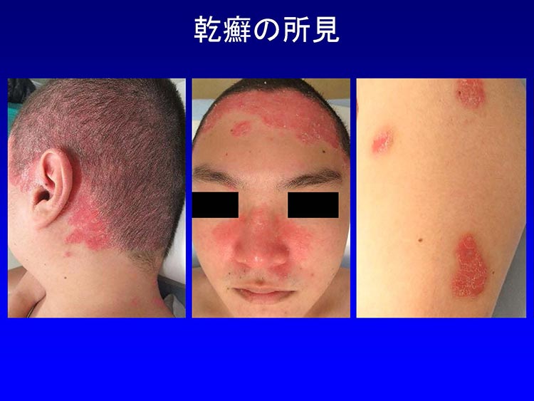 目の周りの湿疹は予防できますか？