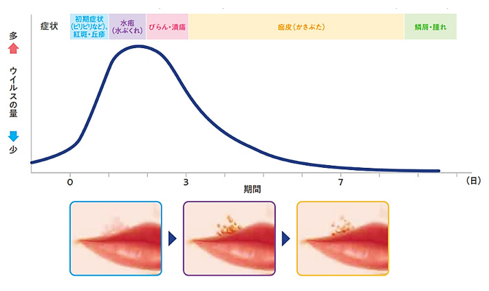 再発性口唇ヘルペスの臨床症状とウイルス量の推移